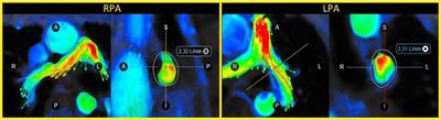 Accurate quantification of pulmonary perfusion ratio in children with congenital heart disease using partial volume corrected 4D flow cardiac magnetic resonance